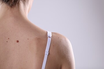 Woman with moles on her body against light background, closeup. Space for text