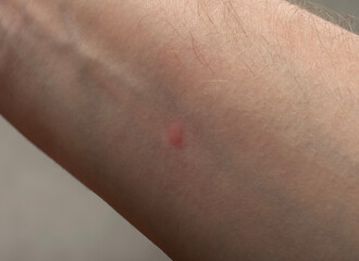 red spot on the hand from a mosquito bite