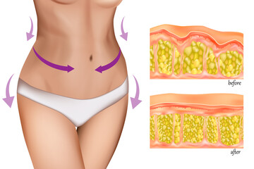 Medical illustration showing a woman's slim waist with directional arrows indicating body contouring, alongside a cross-sectional comparison of fat tissue before and after a slimming procedure. The im