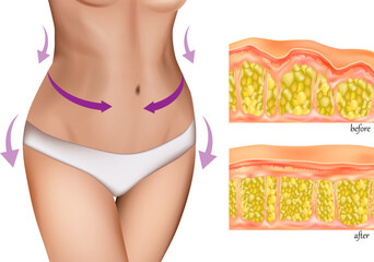 Medical illustration showing a woman's slim waist with directional arrows indicating body contouring, alongside a cross-sectional comparison of fat tissue before and after a slimming procedure. The im