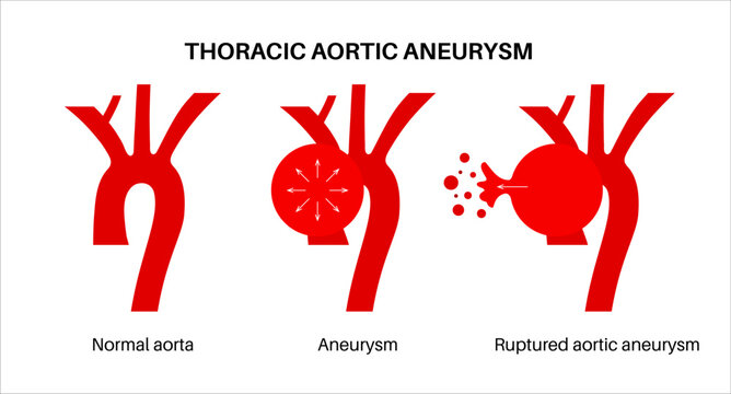 Ruptured thoracic aortic aneurysm