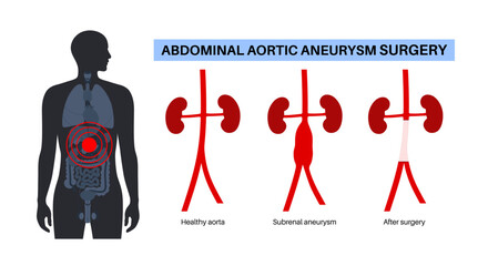 Abdominal Aortic Aneurysm