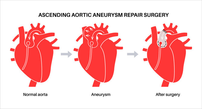 Thoracic aortic aneurysm open surgery