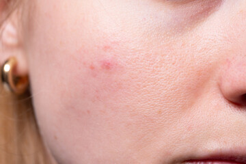 Detailed macro view of female cheek showing inflamed pimples, skin texture, and visible pores. Ideal for skincare, acne, and dermatology themes.