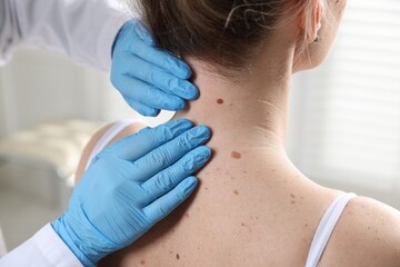 Doctor examining woman's moles in hospital, closeup