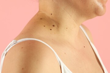Woman with moles on her skin against pink background, closeup