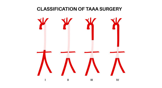 Thoracoabdominal aortic aneurysm surgery