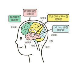高齢者が認知症によって損傷を受ける脳の部分とその名称のイラスト