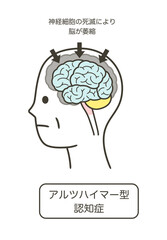アルツハイマー型認知症によって損傷を受ける脳の部分とその名称のイラストのセット