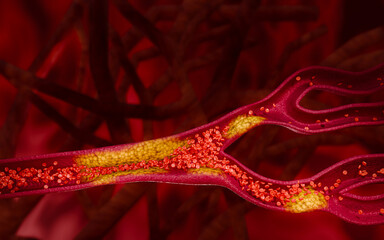 Artery clogged by unhealthy junk food, sugary drinks, and alcohol, illustrating serious cardiovascular risks, atherosclerosis, and heart disease problems in human blood vessels. 3D rendering.