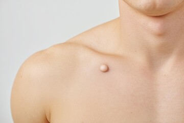 Naklejka premium This Image Presents a Detailed Close-Up View of a Raised Mole Located on the Upper Chest Area. The Photograph Showcases the Intricate Skin Texture and the Natural Coloration of the Mole