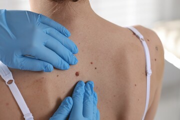 Doctor examining woman's moles in hospital, closeup