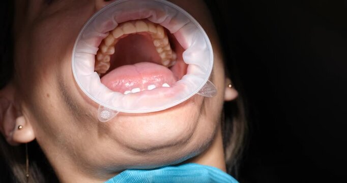 Skilled dentists perform tooth extraction procedure of patient. Multiple gloved hands carefully work together to remove tooth using dental instruments