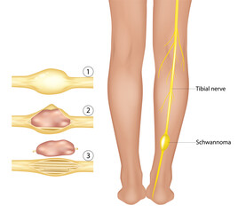 Tibial Nerve Tumor Anatomy. Peripheral Nerve Sheath Tumor in Leg. Schwannoma Medical Visualization. Detailed medical illustration showing the surgical removal of a benign tumor from a tibial nerve. 