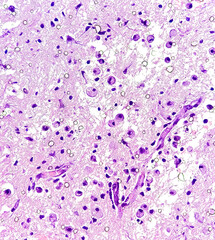 Highly magnified view of brain tumor. Oligodendroglioma of the brain. Brain glioma. Histological slide under microscopy. 
