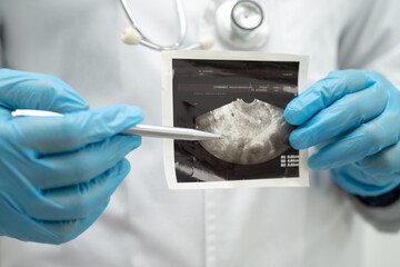 Uterus and ovary, doctor holding anatomy model and ultrasound picture for study diagnosis and treatment in hospital.
