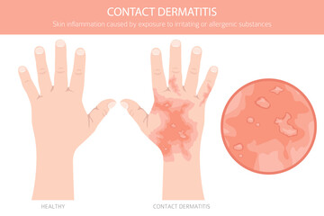 Contact dermatitis. Skin diseases. Medical infographic design. Vector illustration