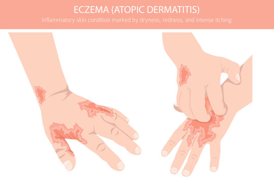 Eczema. Atopic dermatitis. Skin diseases. Medical infographic design. Vector illustration