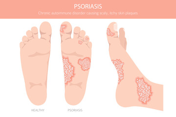 Psoriasis. Skin diseases. Medical infographic design. Vector illustration