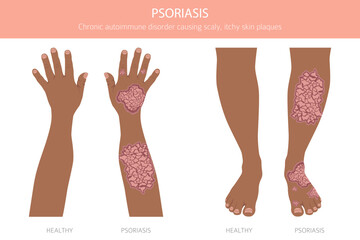 Psoriasis. Skin diseases. Medical infographic design. Vector illustration