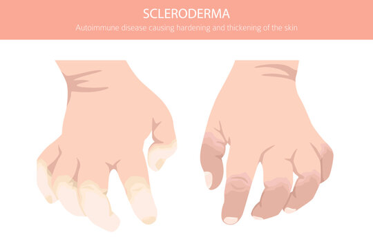 Scleroderma. Skin diseases. Medical infographic design. Vector illustration