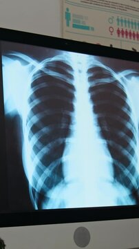 Vertical shot of x-ray scan of human lungs and rib cage on screen of desktop computer standing on workplace of radiologist in modern multidisciplinary medical center or clinics