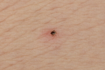 Embedded Deer Tick