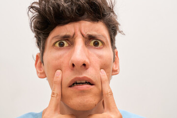 Man with yellow eyes, closeup. Symptom of hepatitis