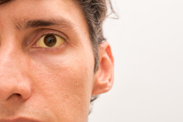 Man with yellow eyes, closeup. Symptom of hepatitis