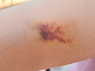 Bruises on the arm indicate an injury from a blow, causing blood vessels under the skin to rupture and leak blood into the surrounding area
