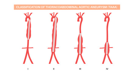 Thoracoabdominal aortic aneurysm surgery