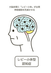 レビー小体型認知症によって損傷を受ける脳の部分とその名称のイラスト