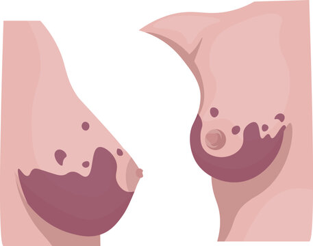 Angiosarcoma is a rare and aggressive malignant tumor originating from the lining of blood vessels or lymphatic vessels.
