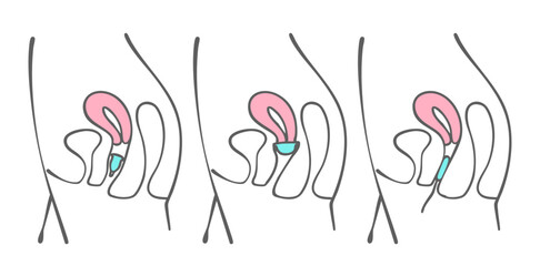 月経カップ、月経ディスク、タンポンの装着位置/Position of menstrual cups, menstrual discs, and tampons