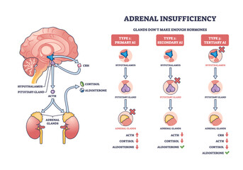 Adrenal insufficiency diagram shows hormone pathways, highlighting brain, adrenal glands, and hormone flow, transparent background.