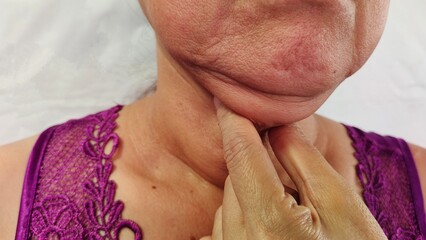 Portrait the fingers holding the flabbiness adipose sagging skin under the neck, neck wattle and cellulite, flabby skin and loose on the throat, health care and beauty concept.