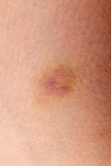 Fototapeta premium Close-Up of a Bruise on Human Skin