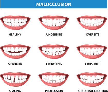 Malocclusion of Human Teeth Vector Illustration (Royalty Free)