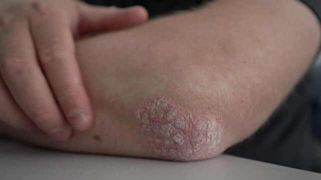 Close-up of a person touching a red, dry patch of skin on their elbow, showing signs of psoriasis or eczema, highlighting a skin condition that requires treatment or care.