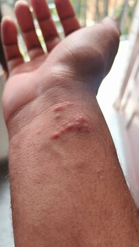 Close-up of a human wrist with visible red bite marks or skin irritation, possibly caused by an insect bite, allergy, or skin infection. Medical skin condition concept.