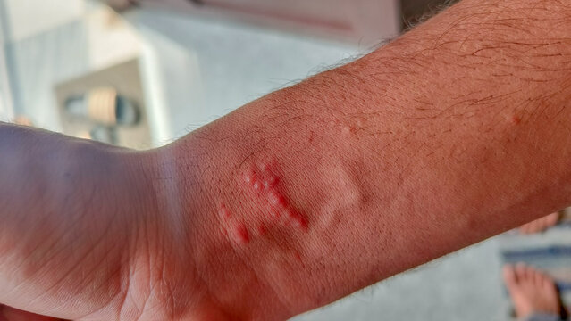 Close-up of a human wrist with visible red bite marks or skin irritation, possibly caused by an insect bite, allergy, or skin infection. Medical skin condition concept.