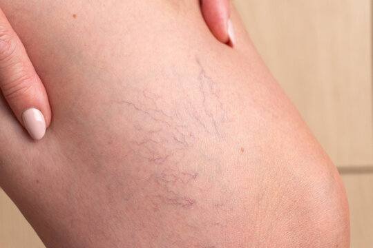 Detailed view of spider veins on female skin. Medical condition of varicose capillaries often found on legs. Used in dermatology, health and wellness content.