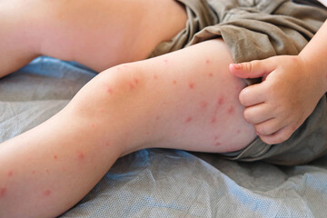 Child scratch body has sensitive itchy skin. Bodily rash. Kid allergy closeup. Little baby...