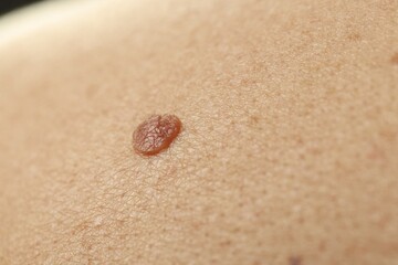 Man with mole on his skin, closeup