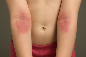 Child's Eczema: Close-up view of a child's arms showing symptoms of eczema, characterized by red, inflamed, and itchy skin.