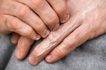 A man creams his dry, cracked hand. Eczema treatment, skin care, body care concept.