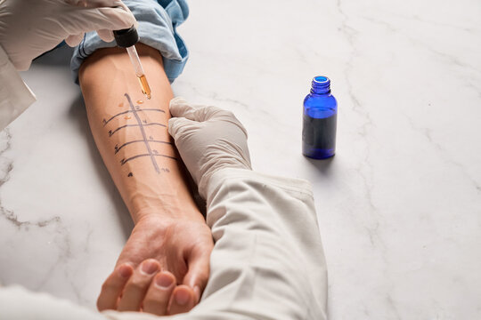 Immunologist Doing Skin Prick Allergy Test on a man's Arm