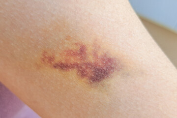 Fototapeta premium Bruises on the arm indicate an injury from a blow, causing blood vessels under the skin to rupture and leak blood into the surrounding area