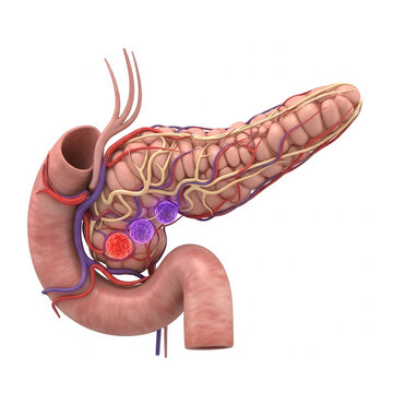 3D render of pancreas showing insulin production issue in diabetes, isolated on white, medical concept image, anatomically accurate