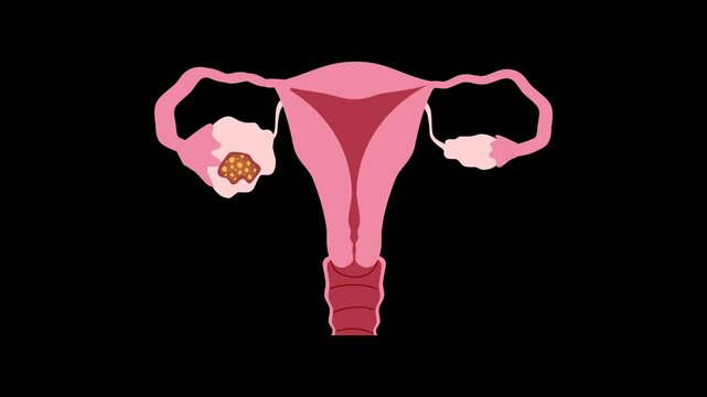Ovarian cancer illustration. World ovarian cancer day concept